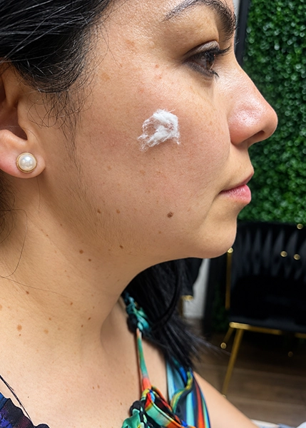 PDO Thread Lift Treatment