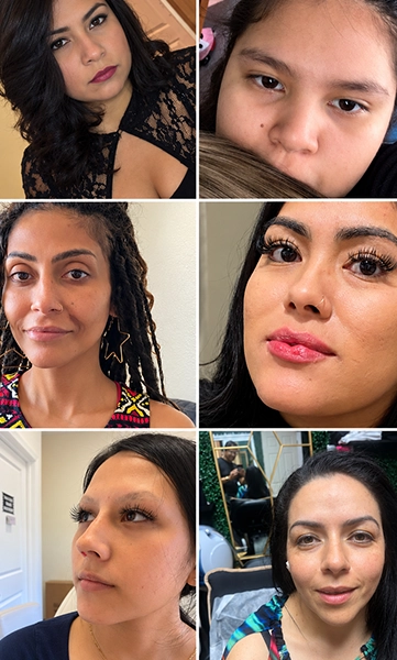 PDO Thread Lift Treatment