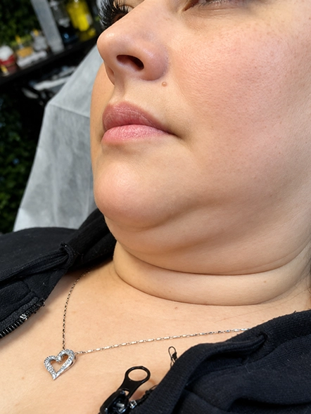 PDO threads on neck