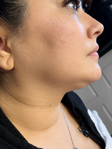 PDO threads on neck